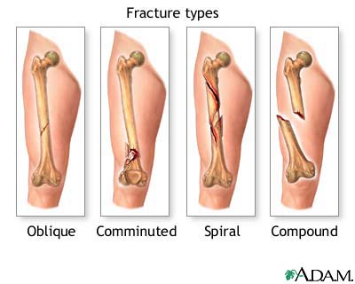 Fracture types (1)