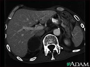 Adrenal metastases, CT scan