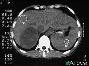 Adrenal Tumor - CT