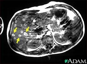 Melanoma of the liver -&#160;MRI scan
