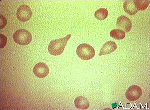 Red blood cells, tear-drop shape