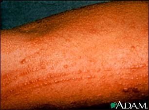 Poison oak rash on the arm