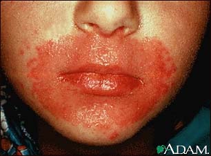 Candidiasis, cutaneous - around the mouth