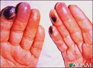 Cryoglobulinemia - of the fingers