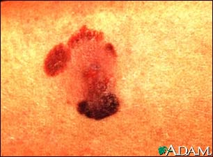 Skin cancer, malignant melanoma