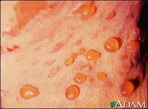 Bullous pemphigoid, close-up of tense blisters
