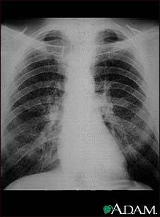 Coal worker's lungs - chest X-ray