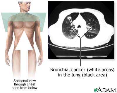 Bronchial cancer - CT scan