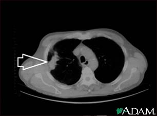 Lung mass, right lung - CT scan