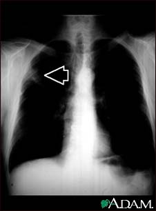 Lung mass, right upper lung - chest X-ray