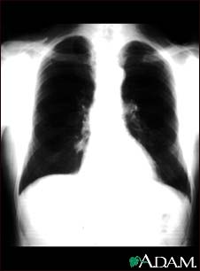 Lung nodule - front view chest X-ray