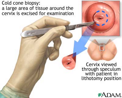 Cold cone biopsy