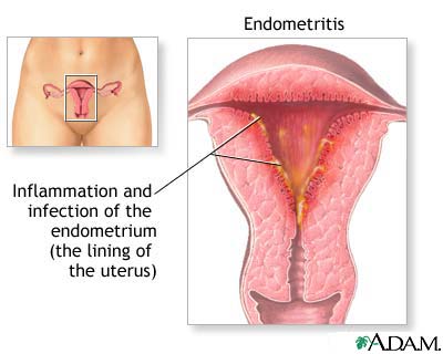 Endometritis