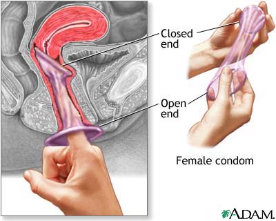 The female condom