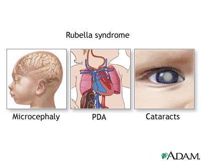 Rubella Syndrome