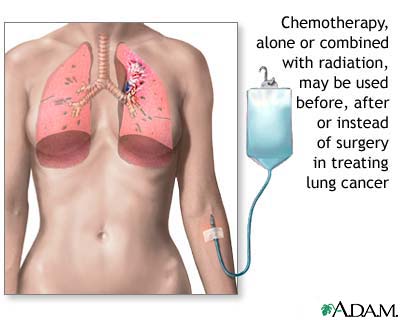 Lung cancer - chemotherapy treatment