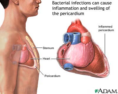 Bacterial pericarditis