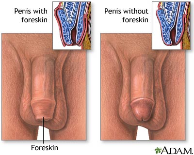 Circumcised vs. uncircumcised