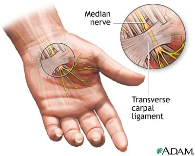 Compression of the median nerve