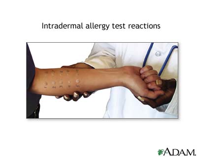 Intradermal allergy test reactions