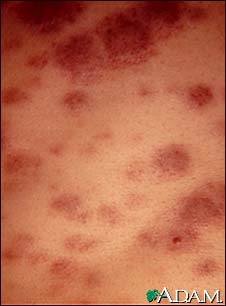 Acute Monocytic Leukemia - Skin