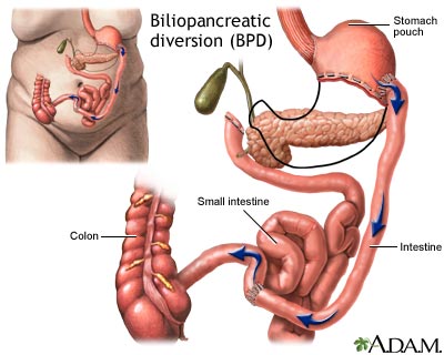 Biliopancreatic diversion (BPD)