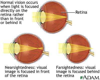 Normal, nearsightedness, and farsightedness