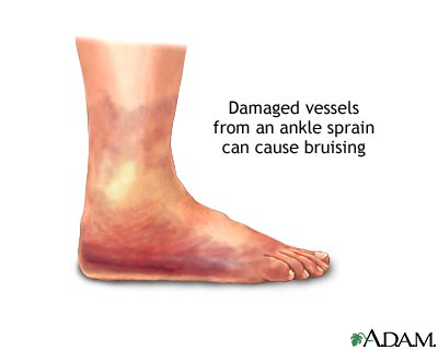 Ankle sprain swelling