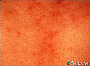 Sarcoid - close-up of the skin lesions