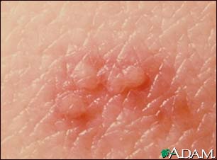 Herpes zoster (shingles) - close-up of lesion