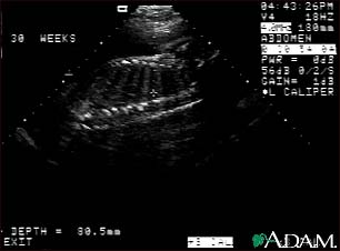 Ultrasound, normal fetus - spine and ribs