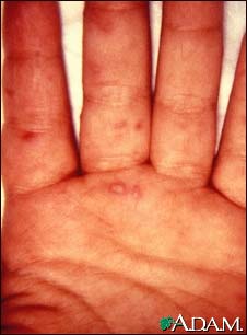 Hand, foot, and mouth disease on the hand