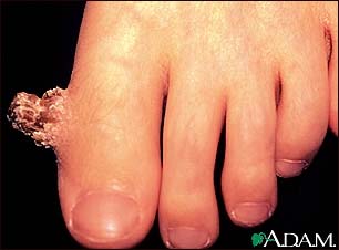 Wart (verruca) with a cutaneous horn on the toe