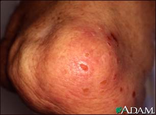 Dermatitis, herpetiformis on the knee