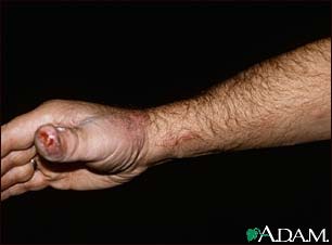 Sporotrichosis on the hand and arm