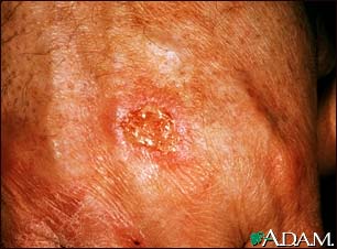 Skin cancer, squamous cell - close-up