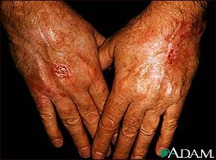Skin cancer, squamous cell on the hands
