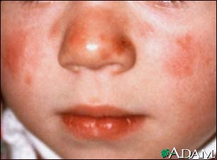 Lupus, discoid on a child's face