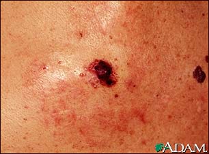 Skin cancer, close-up of level IV melanoma