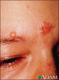 Sarcoidosis on the nose and forehead