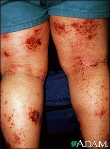 Dermatitis, atopic on the legs