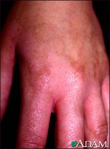 Phytophotodermatitis on the hand
