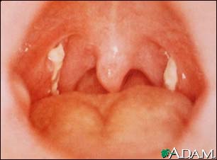 Mononucleosis - view of the throat