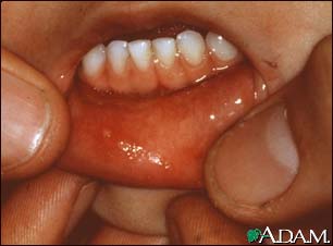 Hand, foot, and mouth disease - mouth