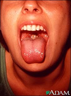 Mononucleosis - mouth