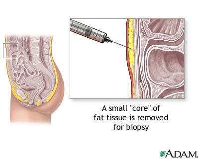 Fat tissue biopsy