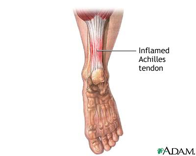 Inflammed achilles tendon