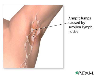 Swollen lymph nodes under arm