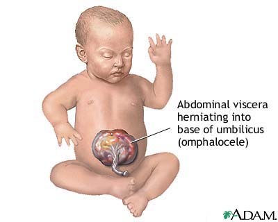Infant omphalocele