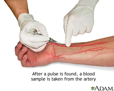 Arterial blood sample
